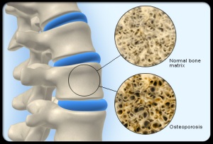 Osteoporosis_s1_bone_density